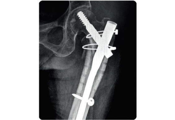 Hệ thống nẹp kim loại CHS